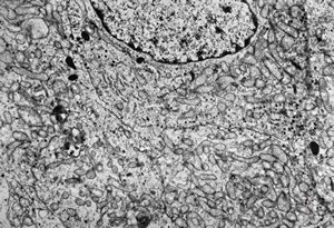 M, 54y. | pituitary adenoma - oncocytic